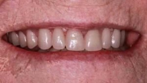 Immediate loading all on - The Grange