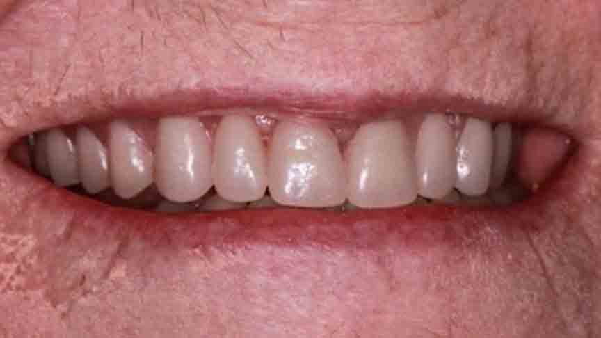 Immediate loading all on - The Grange